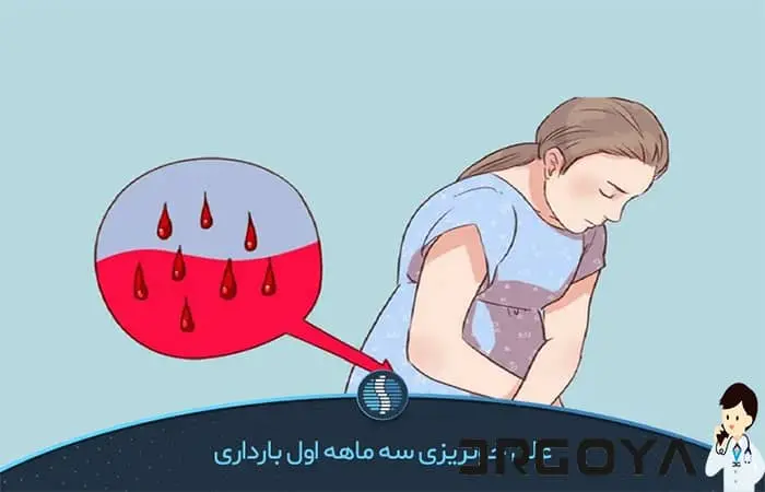 علت خونریزی در سه ماهه اول بارداری