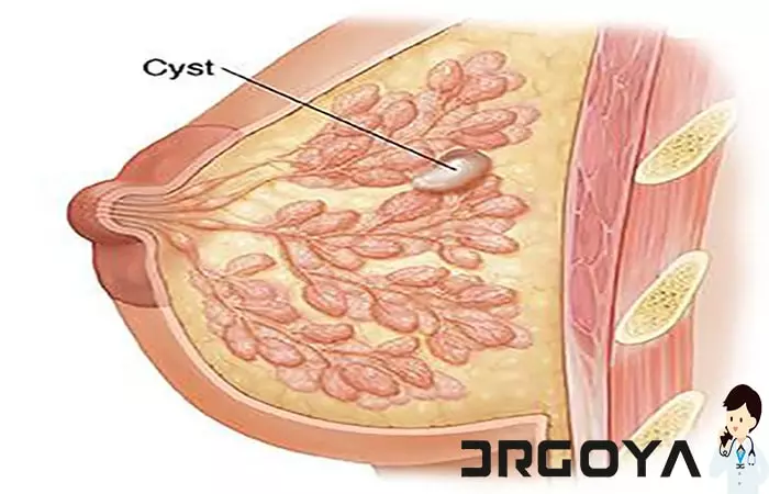 جراحی کیست سینه