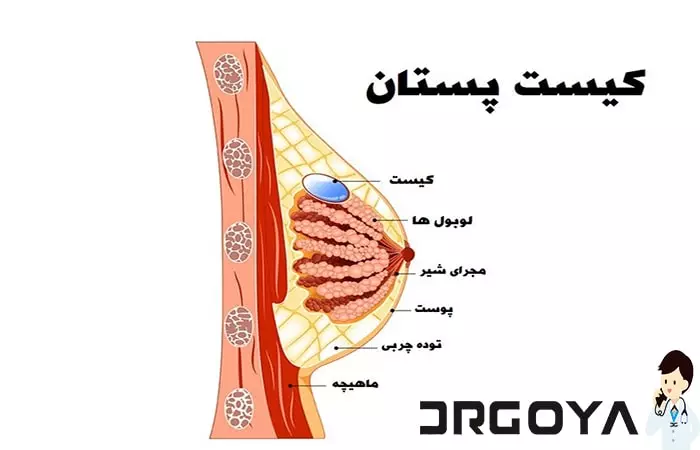 بیماری کیست سینه چیست؟