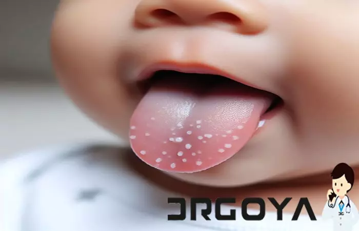 عکس برفک دهان کودک