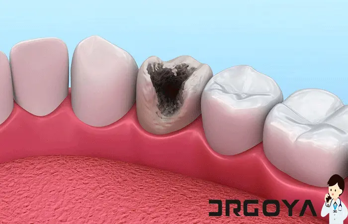 سوراخ شدن دندان چیست؟