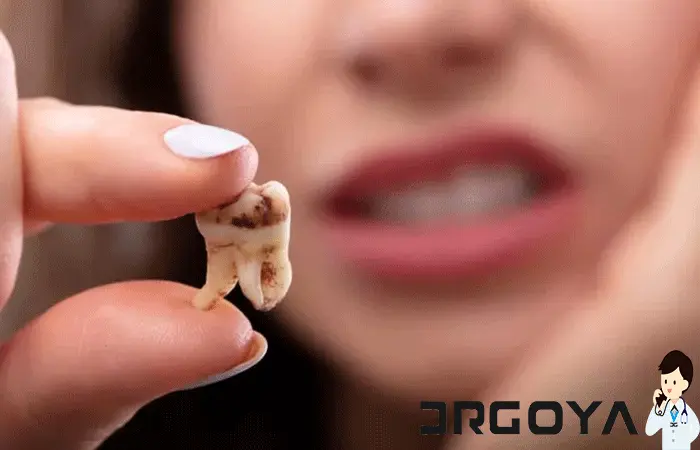 علائم سوراخ شدن دندان چیست؟