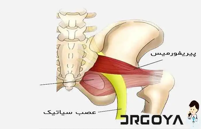 آیا درد سیاتیک در بارداری خطرناک است؟